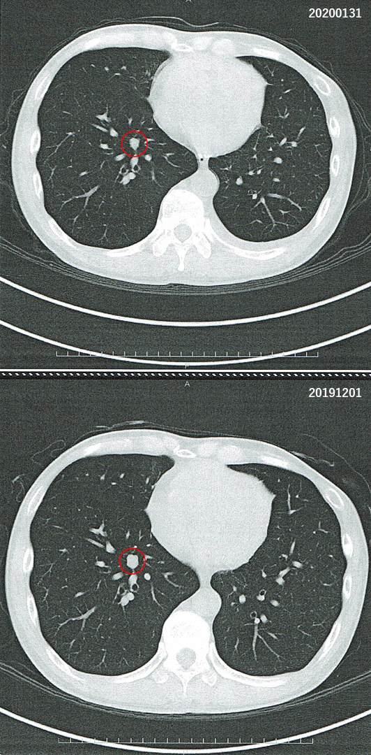 2019年12月1日の胸部CT画像と2020年1月31日の胸部CT画像との比較
