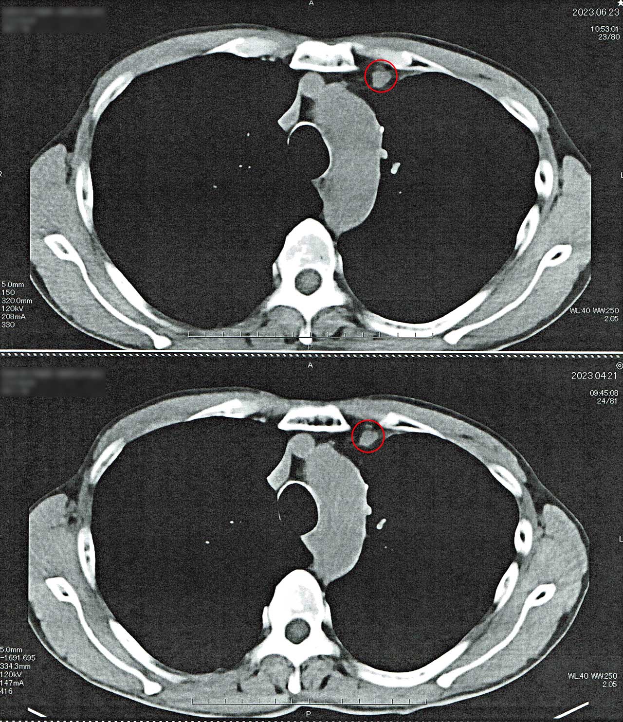 胸部CT リンパ節転移
