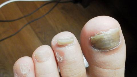 この１ヶ月ほど、はがれかかっていた爪ちゃん。ついに下の方まで、はがれてきてました。
なるべく温存しときたかったので、絆創膏を貼ってたら、皮膚がかぶれちゃったんです。