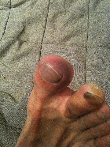 相変わらず汚い足ですが、親指の先端が紫に腫れました。