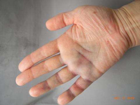 内出血した血液が青紫になり小指、薬指、手のひらに出てきた。実際は画像よりもっと酷い。前の怪我でこれは治癒への順調な経過だということは理解している。