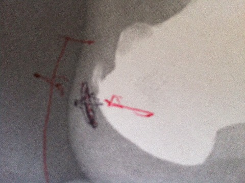 アキレス腱付着部の石灰化。腫れているのはその下の黒ペン部分。