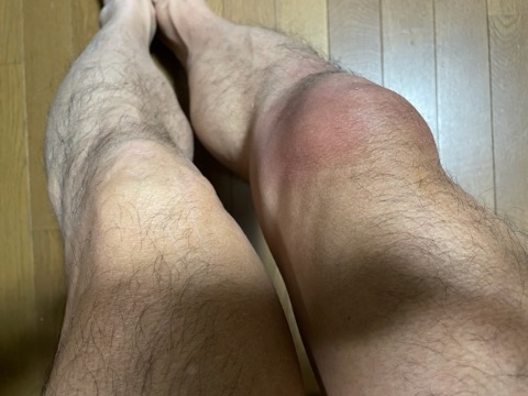 右足の腫れがひどい。痛みはあまりないのだが